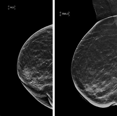 最高 Mammogram Cc Mlo - クールな壁紙