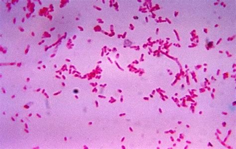 Medicine:Lemierre's syndrome - HandWiki