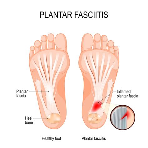 Managing Plantar Fasciitis - Hempstead Therapy Centre