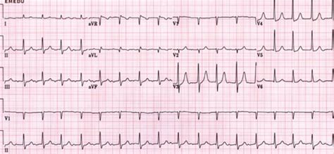 Truth of The Talisman: Ekg Flashcards Quizlet