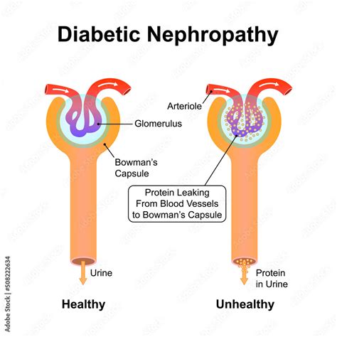 Scientific Designing of Diabetic Nephropathy. Common Complication of Type 1 and Type 2 Diabetes ...