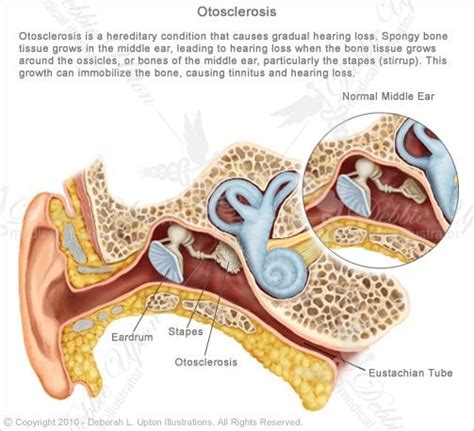 otosclerosis - Google Search | Step 3 McGee! | Pinterest | Google search