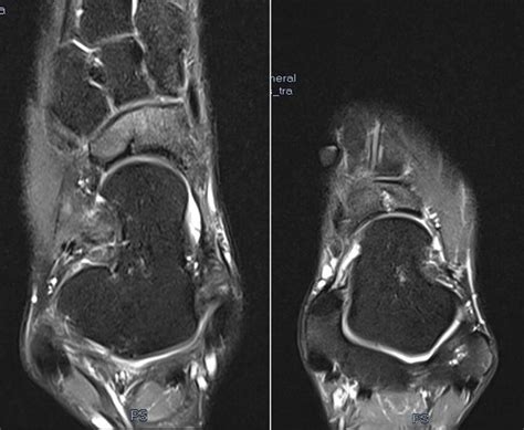 MRI showing bilateral navicular stress fractures. | Download Scientific Diagram