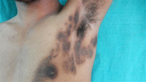 Acanthosis Nigricans: Appearance, Causes, and Treatment