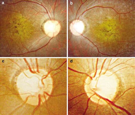 Fundus retinography showing bull’s eye maculopathy in (a) right eye and ...