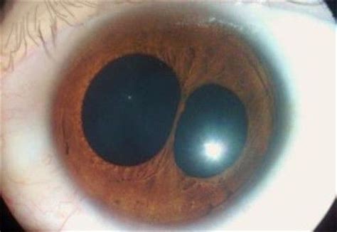 Polycoria is a very rare pathological condition of the eye ...