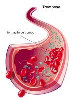 Thrombose : causes, symptômes & traitements | Creapharma