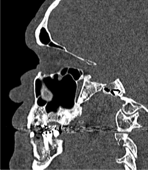 sagital computed tomography image showing vidian nerve crossing place. | Download Scientific Diagram