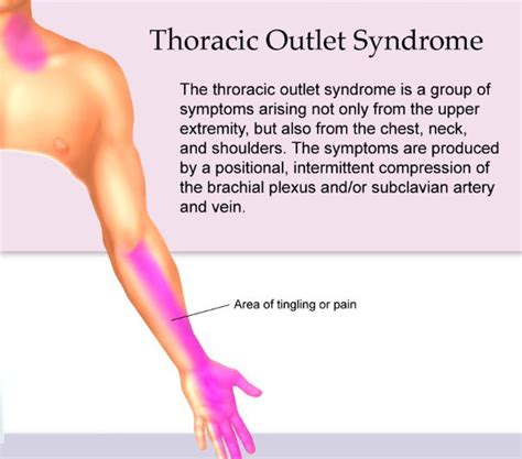 Thoracic Outlet Syndrome and Chiropractic