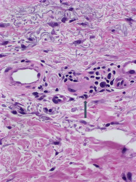 Pathology Outlines - Pigmented purpuric dermatosis