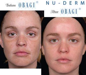 Obagi® Before and After Pictures – Micki Ly M.D. Maui Dermatologist