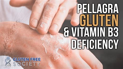 Pellagra, Gluten, & Vitamin B3 Deficiency - Gluten Free Society