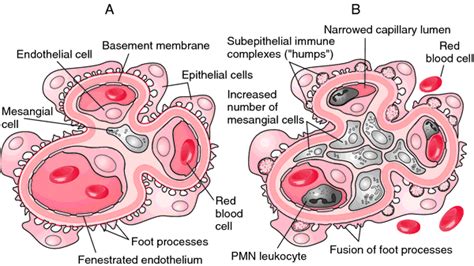 MEDICAL PG QUESTION BANK: Membranoproliferative Glomerulonephritis