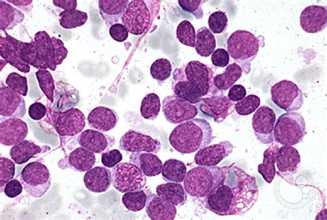 Precusor B-cell Acute Lymphoblastic Leukemia - 8.