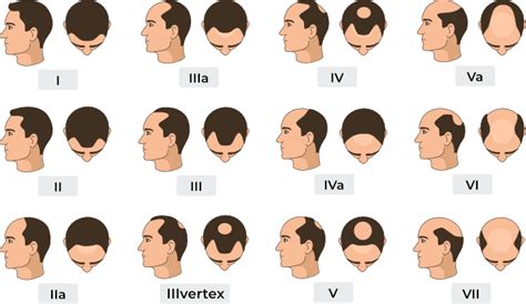 Norwood Scale: Stages, Causes & Treatments - HairPalace Clinic