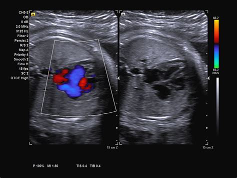 color-doppler-of-fetal-heart-02478264~10 | Profimedical - aparaty USG ...