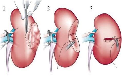 Right Laparoscopic Radical Nephrectomy