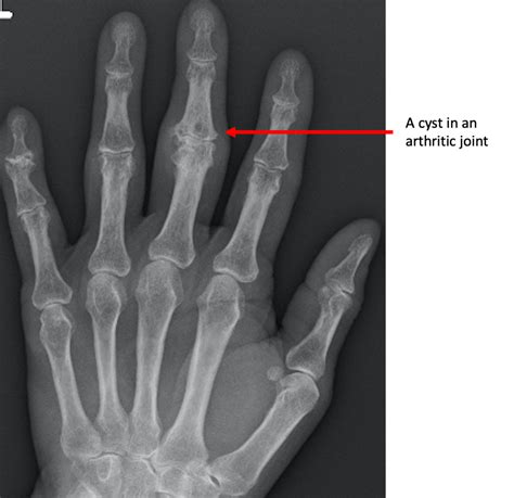 Osteoarthritis Hands X Ray