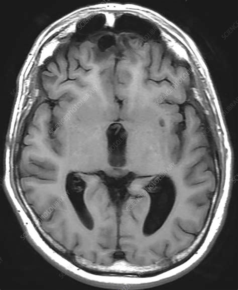 Chronic Post-Traumatic Brain Injury, MRI - Stock Image - C030/6067 - Science Photo Library