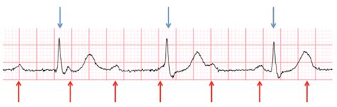 3rd Degree Heart Block Ecg Strip - Photos Idea