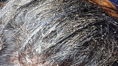 What Do Head Lice Nits Look Like - Infoupdate.org