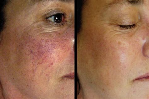 Broken Capillaries Treatment –– by Advanced Dermatology