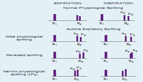 Medicine Decoded: Splitting of Second heart sound