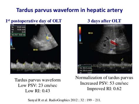 Ultrasound & doppler ultrasound in liver transplantation