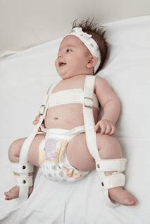 hip dysplasia baby brace australia - I Got Some Good Portal Picture Archive