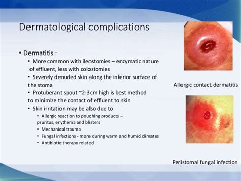 Stoma Complications Pictures - the meta pictures