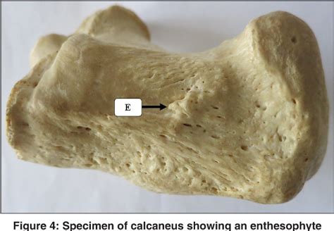 Figure 4 from Enthesophytes and Tubercles of the Calcaneum: An Anatomical and Clinical ...