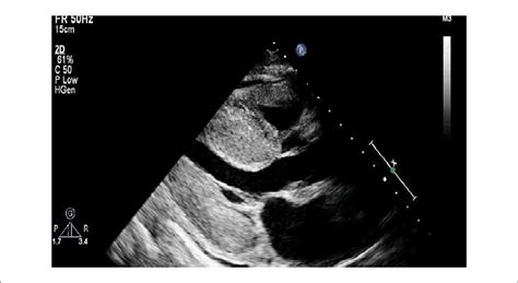 Echo Clues: When to Suspect Amyloidosis - Cardiac Wire