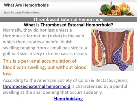 Thrombosed External Hemorrhoid