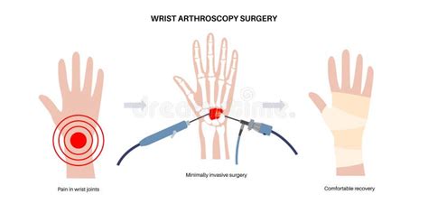 Wrist arthroscopy surgery stock illustration. Illustration of rheumatoid - 331026561