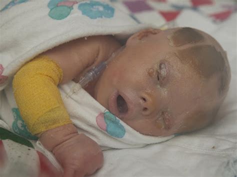 Meet Brenna, a baby with Harlequin Ichthyosis - Photo 24 - Pictures - CBS News