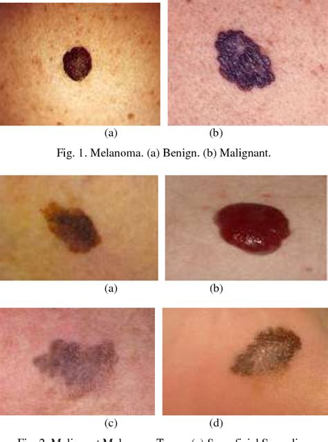 [PDF] Early Detection and Classification of Melanoma Skin Cancer | Semantic Scholar