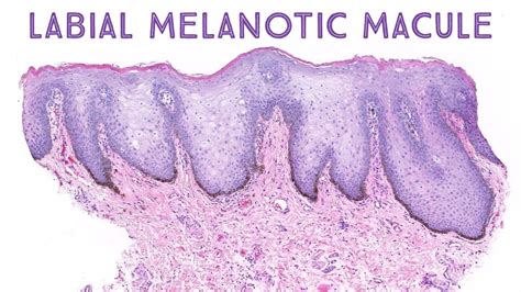 Labial melanotic macule (brown spot on lip) (Stony Brook Case 1) dermatology dermatopathology ...