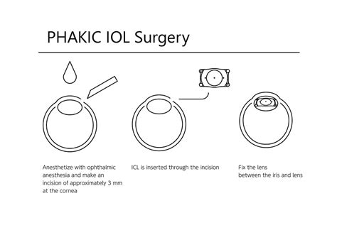 Phakic IOL - Muscat Eye Laser Center