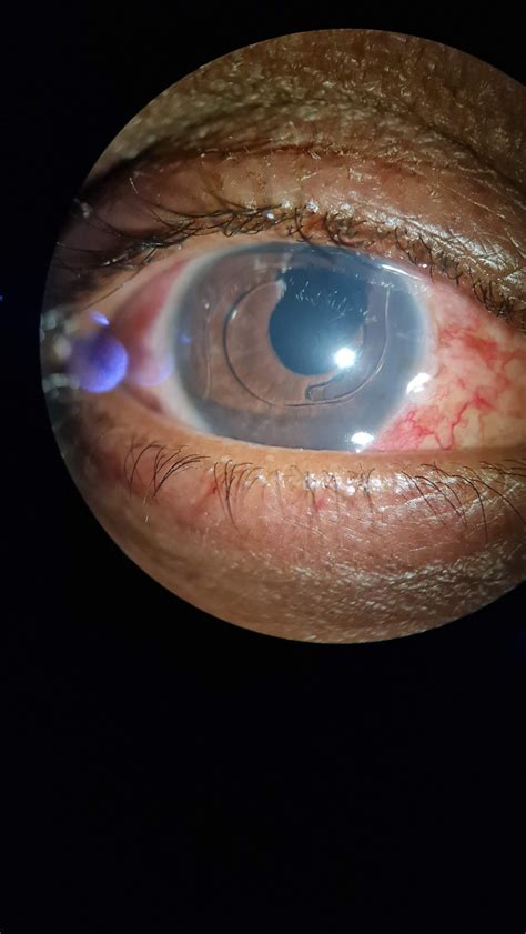 [Figure, Uveitis Hyphema Glaucoma Syndrome Indicating...] - StatPearls ...