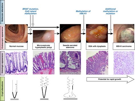 Sessile Serrated Adenomas: An Evidence-Based Guide to Management ...