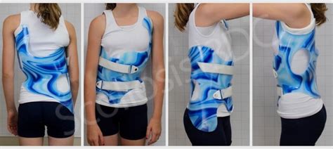 Cheneau-Gensingen Brace | Scoliosis Brace | TLSO | Cheneau Brace