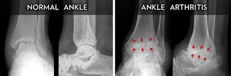 Ankle Arthritis Surgery - Dr. Neal Blitz | New York, NYC