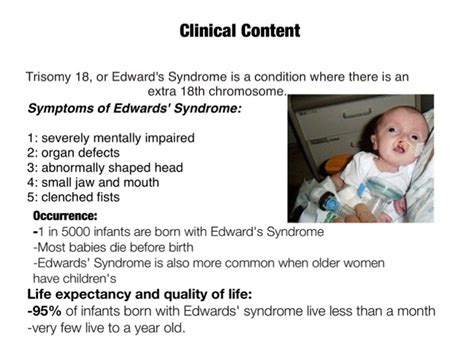 what is the life expectancy of someone with edwards syndrome ...