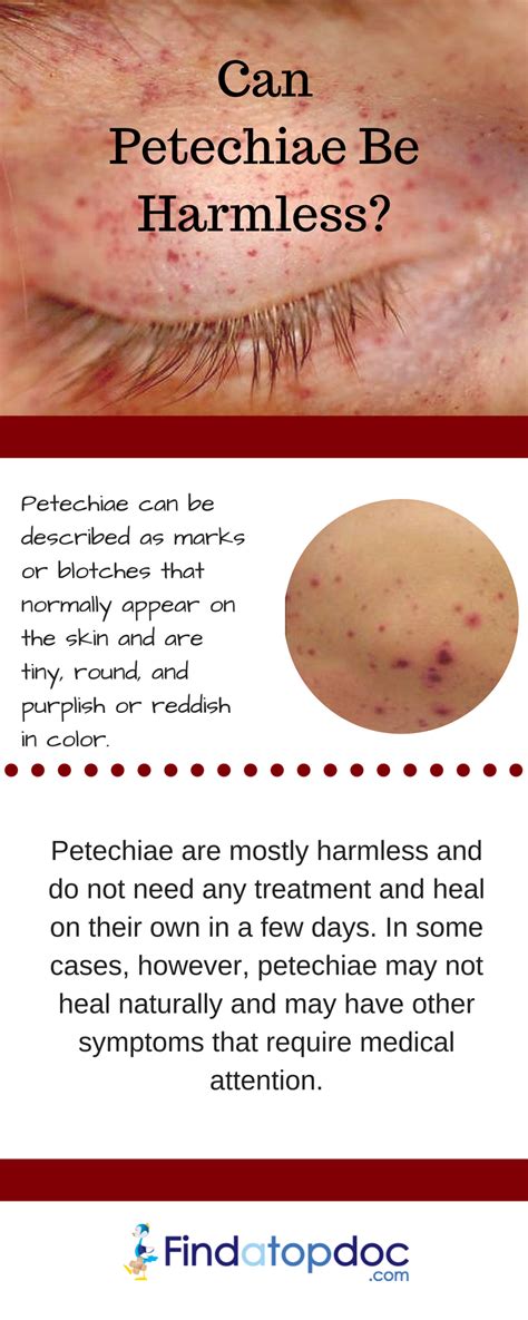 What Are Petechiae and Causes of Petechiae?