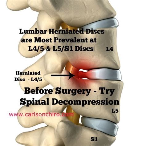 Pin on Disc Prolapse: Slipped Bulged Disc