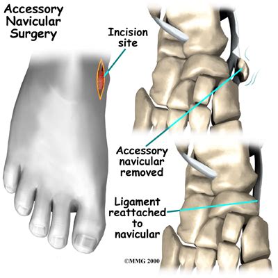 Physical Therapy in our clinic for Accessory Navicular Problems