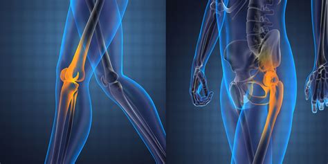 Knee And Hip Replacement - Orthopedic Surgeon Monmouth County NJ | Marshall P. Allegra, M.D.