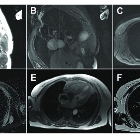 | Cardiac magnetic resonance images of cardiac paraganglioma. (A)... | Download Scientific Diagram