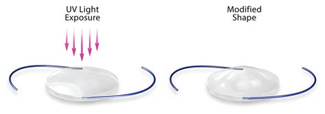 Premium IOLs for cataract surgery vs. traditional IOL lens implants