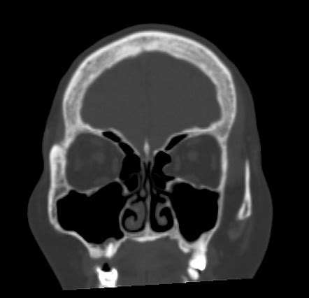 Lamina Papyracea Anatomy